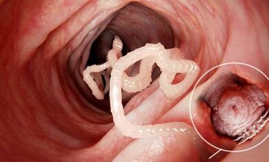 come riconoscere la presenza di parassiti nell'intestino umano